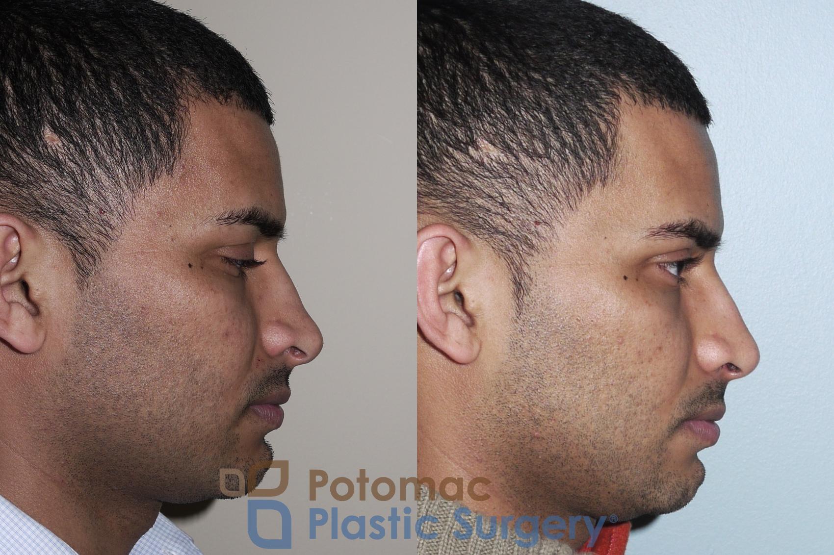 Before & After Rhinoplasty - Medical Case 25 Right Side View in Washington DC & Arlington , DC