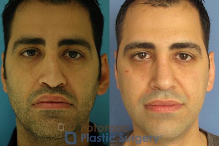 Before & After Rhinoplasty - Cosmetic Case 3 Front View in Washington DC & Arlington , DC