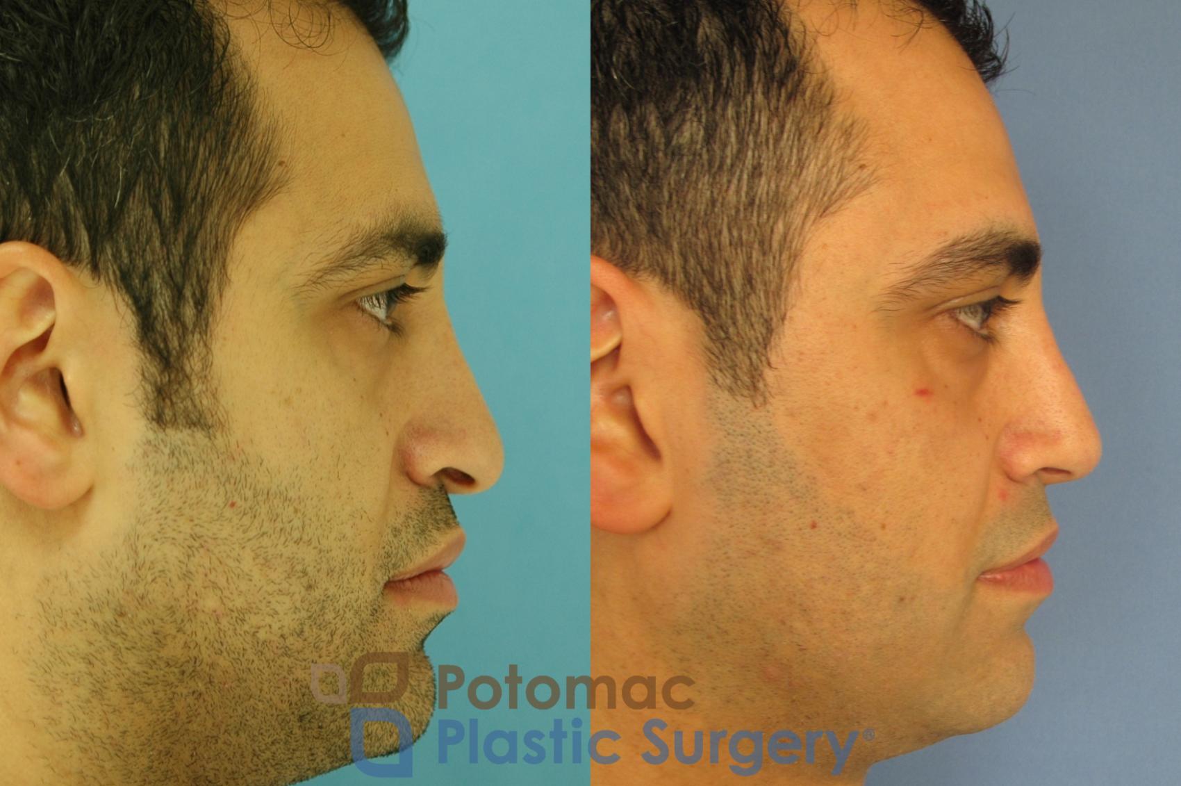 Before & After Rhinoplasty - Medical Case 3 Right Side View in Washington DC & Arlington , DC