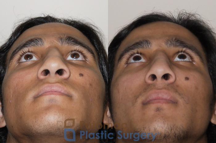 Before & After Rhinoplasty - Medical Case 44 Bottom View in Arlington, VA & Washington, DC