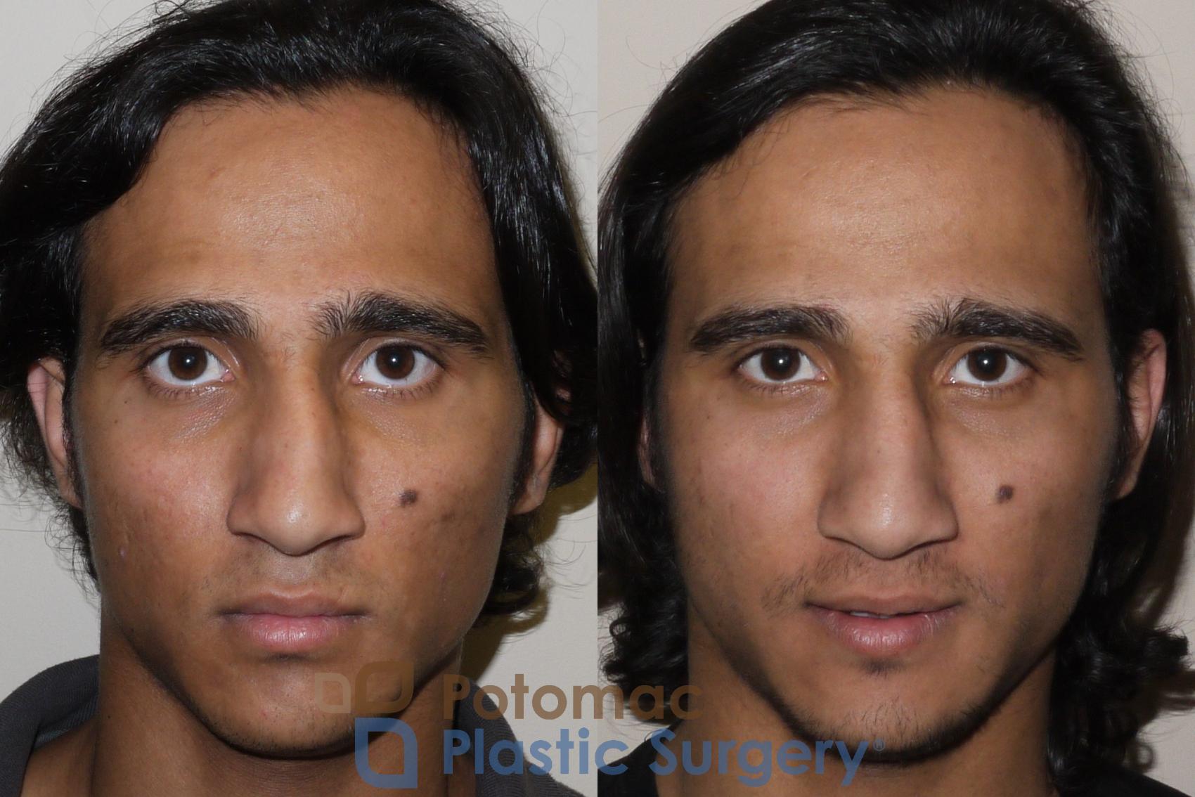 Before & After Rhinoplasty - Medical Case 44 Front View in Arlington, VA & Washington, DC