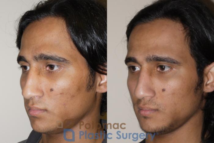 Before & After Rhinoplasty - Medical Case 44 Left Oblique View in Arlington, VA & Washington, DC