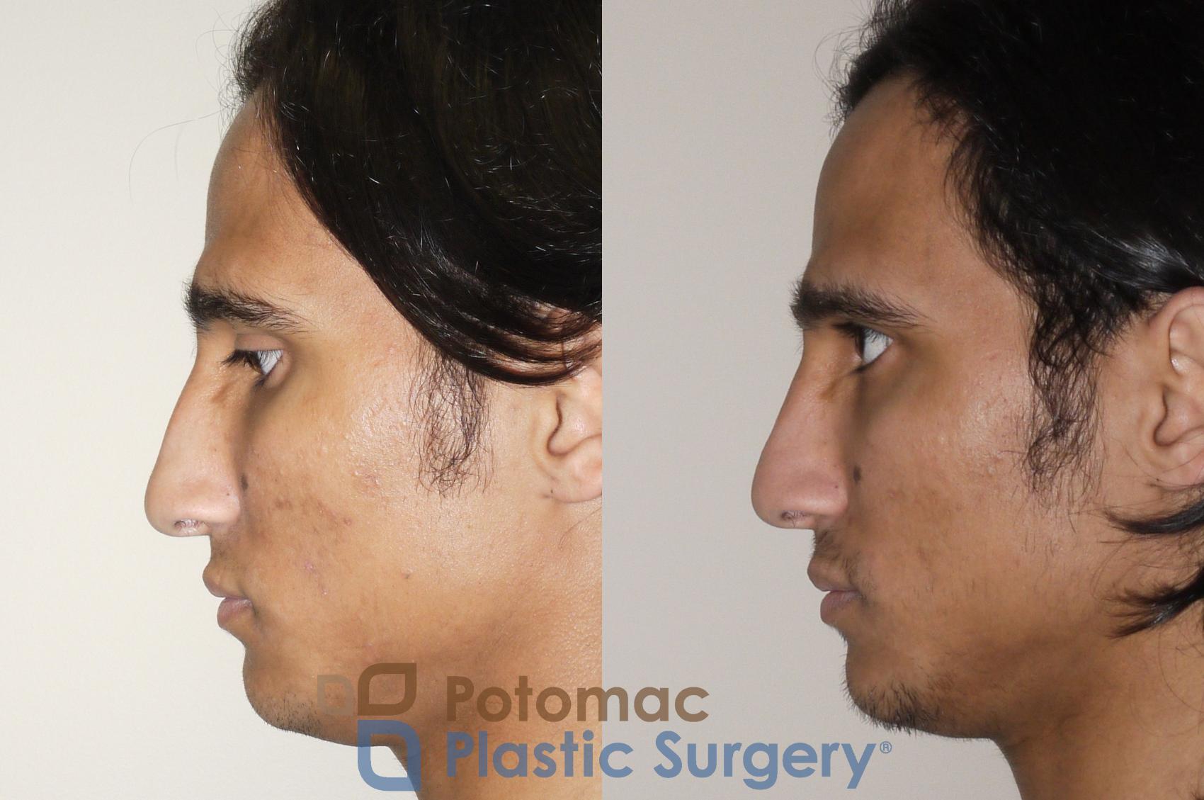 Before & After Rhinoplasty - Medical Case 44 Left Side View in Washington DC & Arlington , DC
