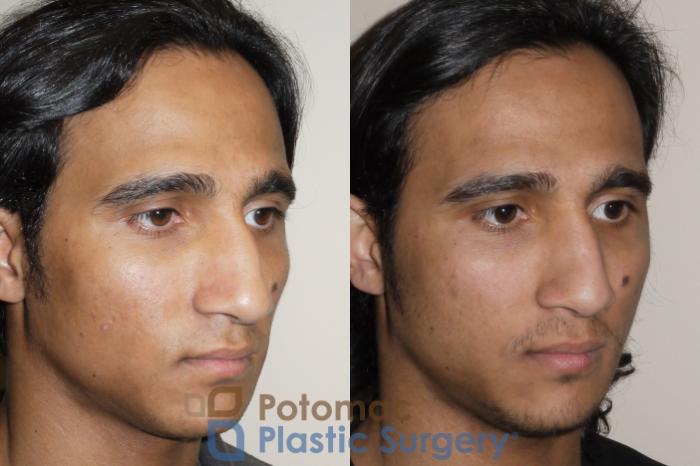 Before & After Rhinoplasty - Medical Case 44 Right Oblique View in Arlington, VA & Washington, DC