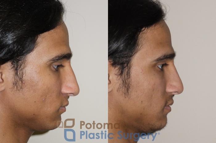Before & After Rhinoplasty - Medical Case 44 Right Side View in Arlington, VA & Washington, DC