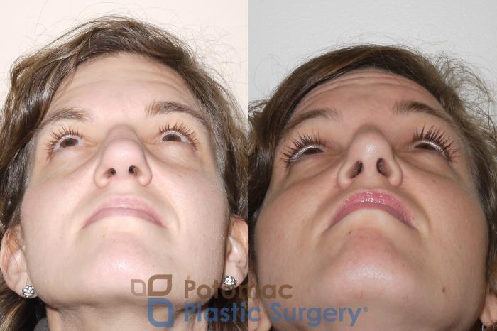 Before & After Rhinoplasty - Cosmetic Case 62 Below View in Washington DC & Arlington , DC