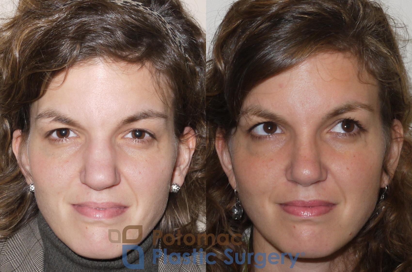 Before & After Rhinoplasty - Medical Case 62 Front View in Washington DC & Arlington , DC