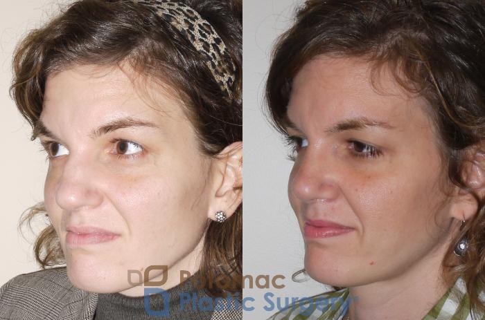 Before & After Rhinoplasty - Medical Case 62 Left Oblique View in Washington DC & Arlington , DC
