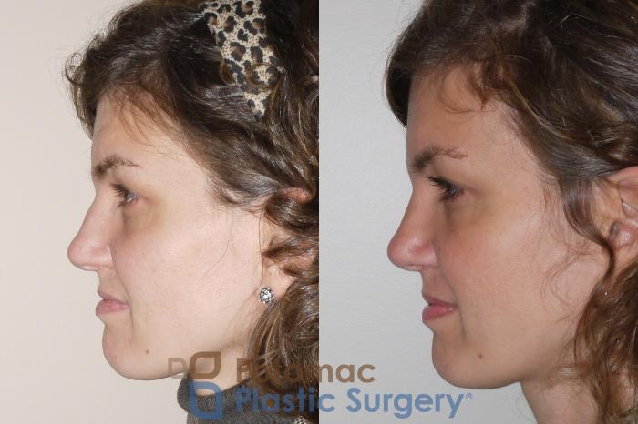Before & After Rhinoplasty - Cosmetic Case 62 Left Side View in Washington DC & Arlington , DC