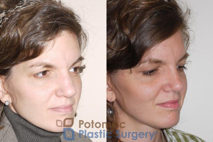 Before & After Rhinoplasty - Cosmetic Case 62 Right Oblique View in Washington DC & Arlington , DC