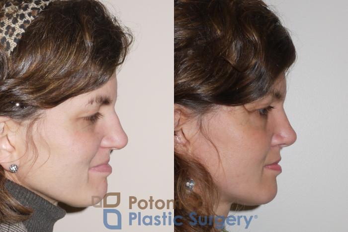 Before & After Rhinoplasty - Cosmetic Case 62 Right Side View in Washington DC & Arlington , DC
