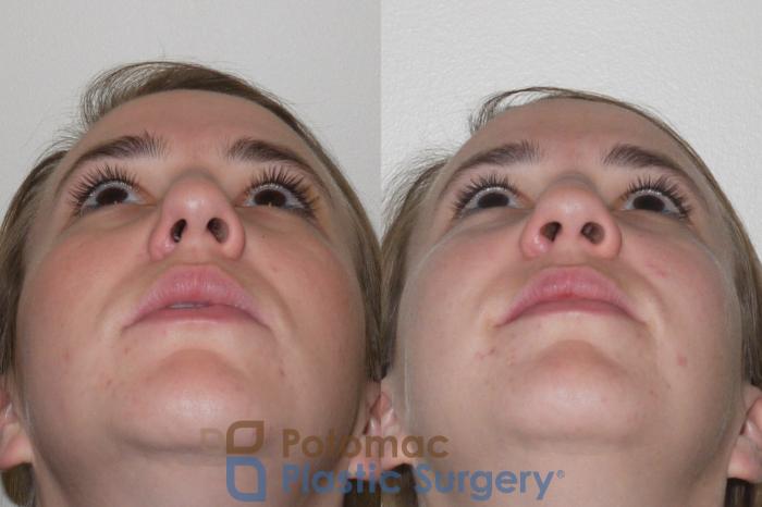 Before & After Rhinoplasty - Cosmetic Case 98 Bottom View in Washington DC & Arlington , DC