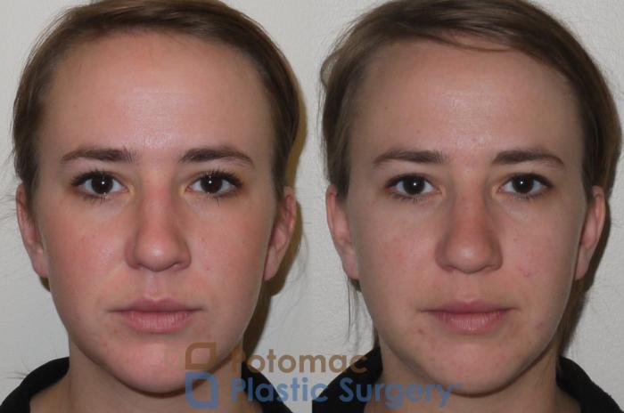 Before & After Rhinoplasty - Cosmetic Case 98 Front View in Washington DC & Arlington , DC