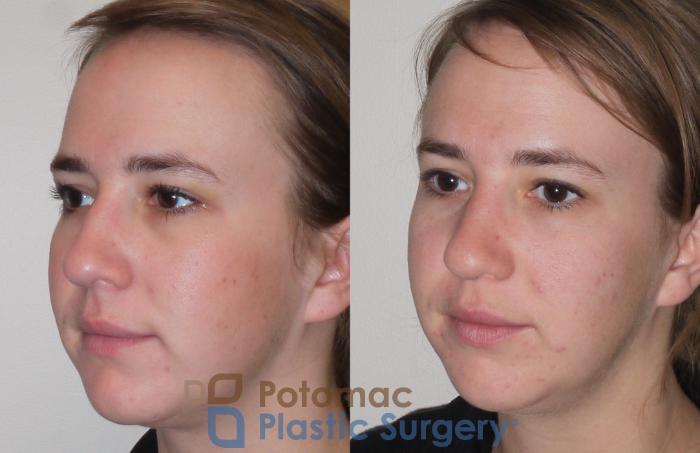 Before & After Rhinoplasty - Medical Case 98 Left Oblique View in Washington DC & Arlington , DC
