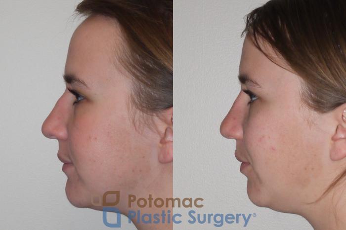 Before & After Rhinoplasty - Cosmetic Case 98 Left Side View in Washington DC & Arlington , DC