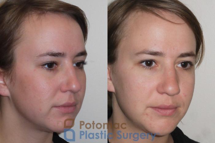 Before & After Rhinoplasty - Cosmetic Case 98 Right Oblique View in Washington DC & Arlington , DC