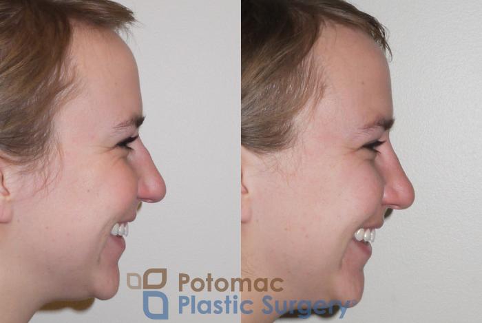 Before & After Rhinoplasty - Cosmetic Case 98 Right Side - Smiling View in Washington DC & Arlington , DC