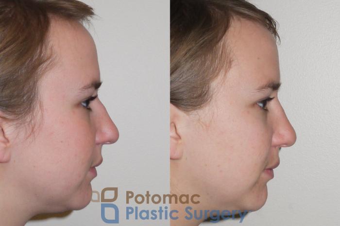 Before & After Rhinoplasty - Medical Case 98 Right Side View in Washington DC & Arlington , DC
