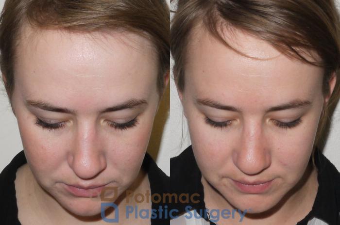 Before & After Rhinoplasty - Medical Case 98 Top View in Washington DC & Arlington , DC