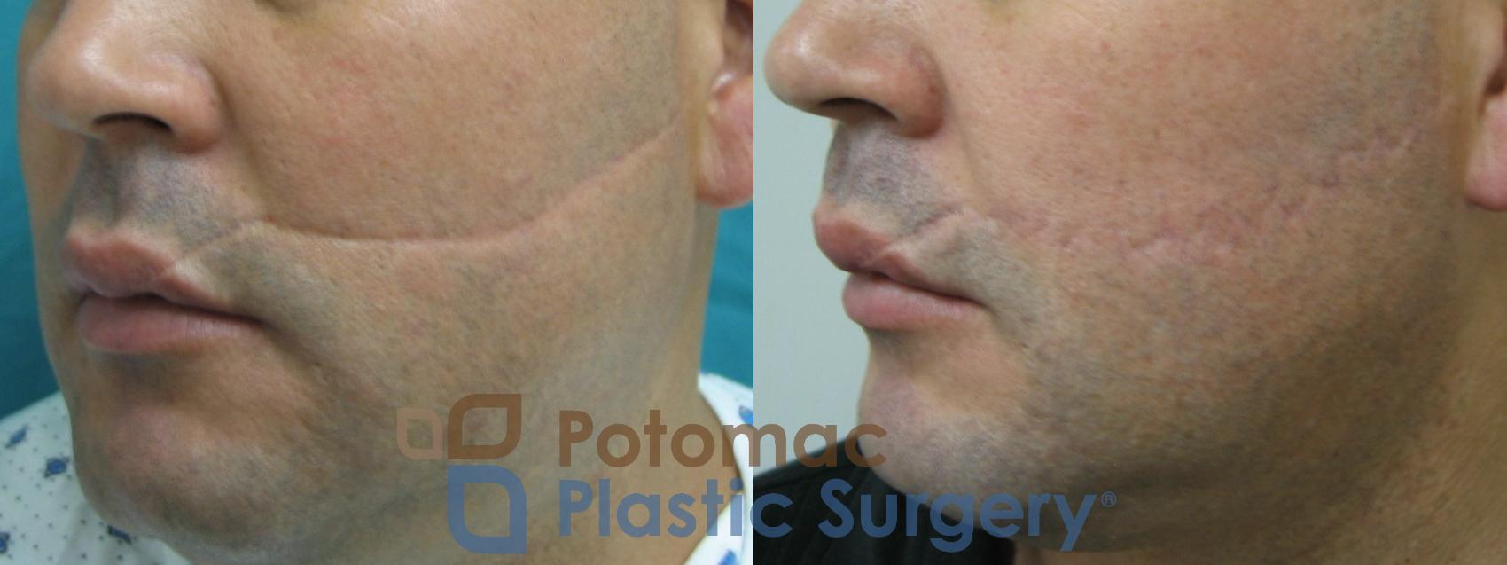 Before & After Scar Revision Case 9 Left Oblique View in Washington, DC