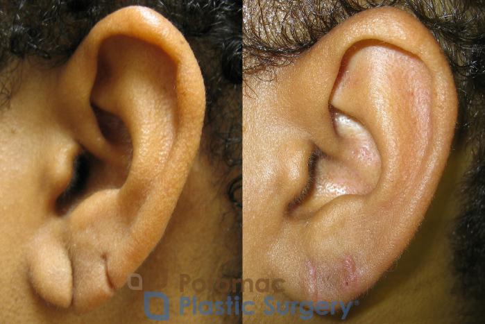 Before & After Torn Ear Lobe Case 11 Left Side View in Washington DC & Arlington , DC