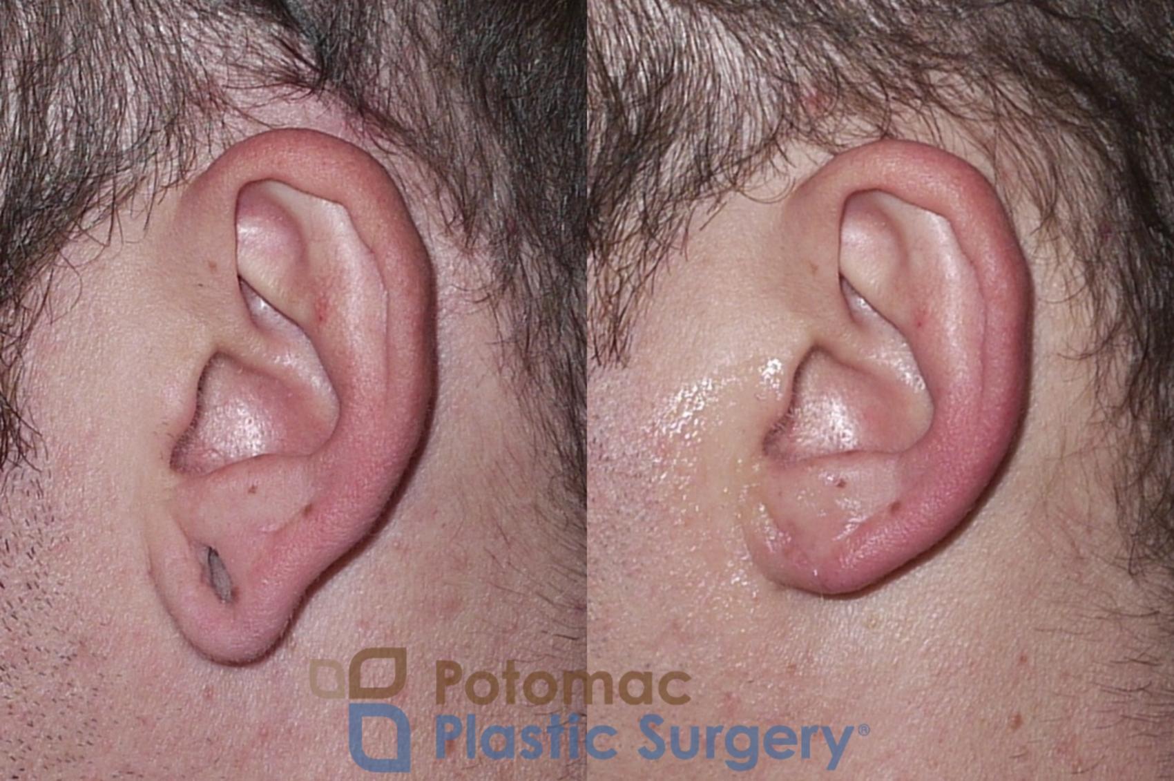 Before & After Torn Ear Lobe Case 34 Left Side View in Washington, DC