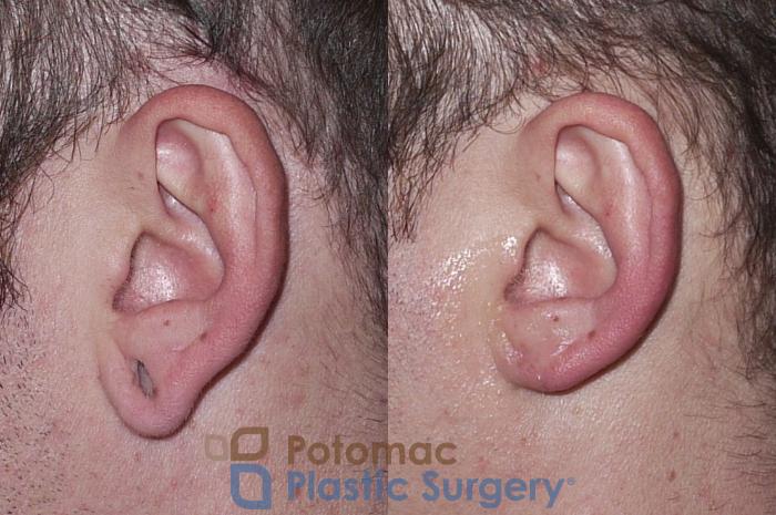 Before & After Torn Ear Lobe Case 34 Left Side View in Washington DC & Arlington , DC